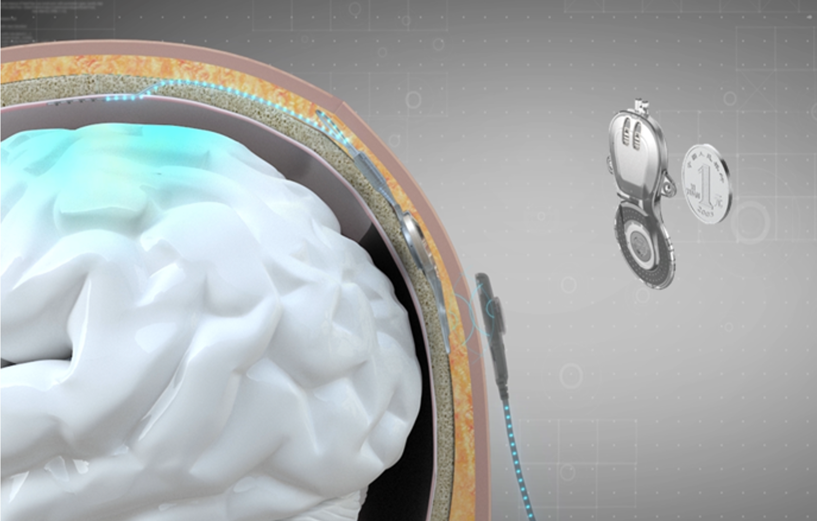 NEO anatomical rendering showing the epidural array, skull-seated implant and external coil in relation to the scalp and brain.