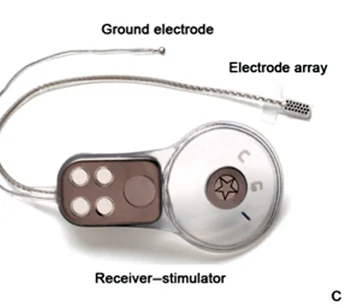 Cochlear auditory brainstem implant receiver-stimulator with lead, ground electrode and the brainstem contact paddle.