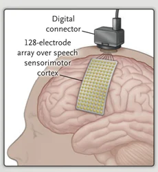 Original 2021 source drawing of the 128-contact PMT cortical grid and percutaneous connector, placed on speech sensorimotor cortex.