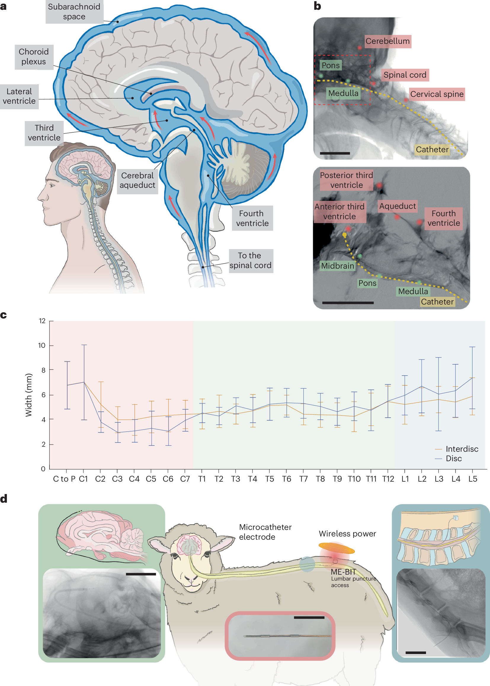 Endocisternal interface figure showing human and sheep anatomy, catheter fluoroscopy and a close-up of the catheter electrode tip.