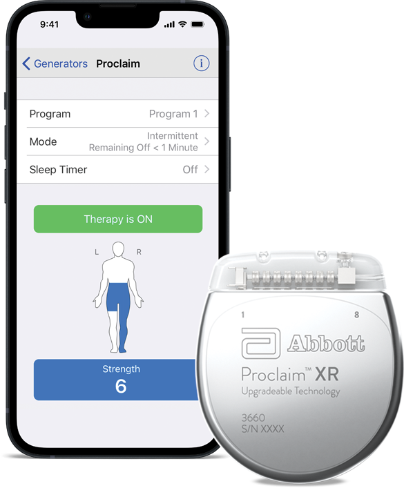 Abbott Proclaim XR implantable pulse generator beside a phone running the external patient-controller app.
