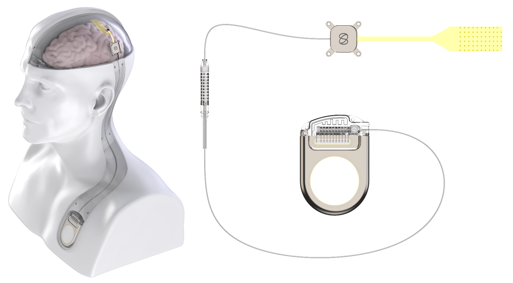Manufacturer rendering of NeuroXess Triple-F with a flexible cortical contact array, skull unit, connecting lead and internal battery module beside an anatomical head.